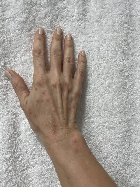 A hand with insect bites displayed on a towel.