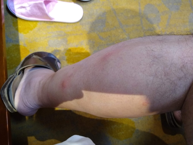 Close-up of a leg with injuries.