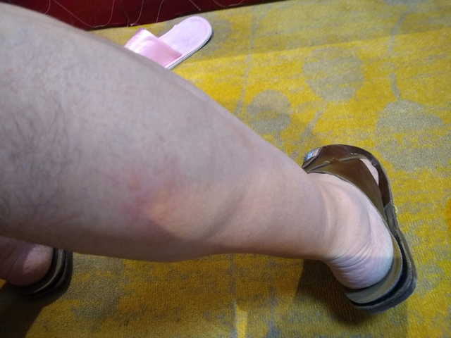 Close-up of a leg with an injury.